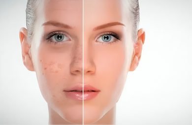 What Causes Dark Spots and How to Treat Them 3 What Causes Dark Spots and How to Treat Them
