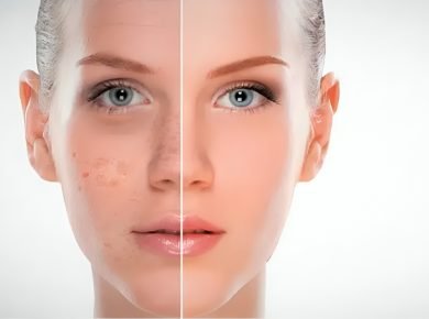 What Causes Dark Spots and How to Treat Them 2 What Causes Dark Spots and How to Treat Them
