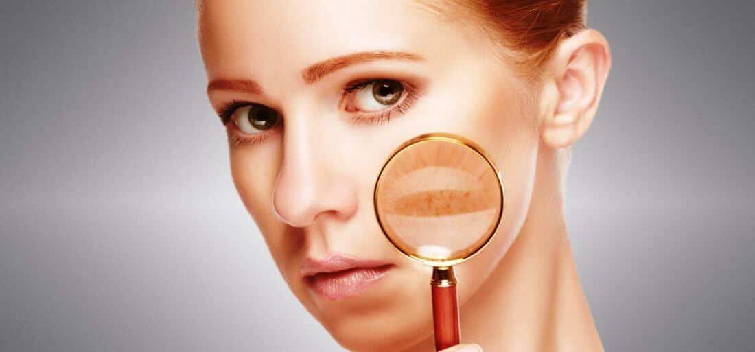 What Causes Dark Spots and How to Treat Them 8 What Causes Dark Spots and How to Treat Them