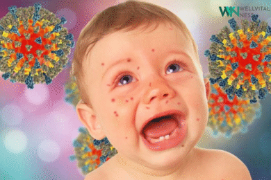 Chickenpox Explained: Symptoms, Causes, Treatment & Prevention 6 chickenpox