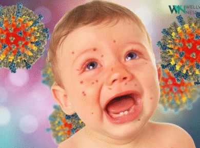 Chickenpox Explained: Symptoms, Causes, Treatment & Prevention 18 chickenpox