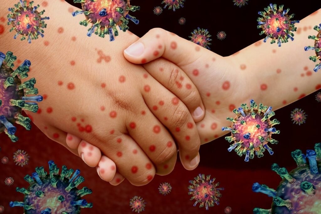 Chickenpox Explained: Symptoms, Causes, Treatment & Prevention 2 Chickenpox Explained: Symptoms, Causes, Treatment & Prevention