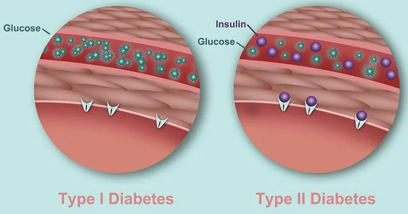 Diabetes Demystified: Causes, Types, Symptoms, Treatment & Essential Diet Tips 2 Diabetes Demystified: Causes, Types, Symptoms, Treatment & Essential Diet Tips